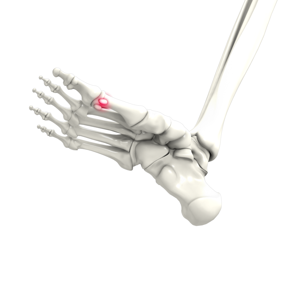 Sesamoiditis