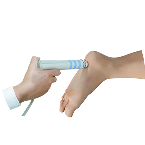 Extracorporeal Shockwave Therapy