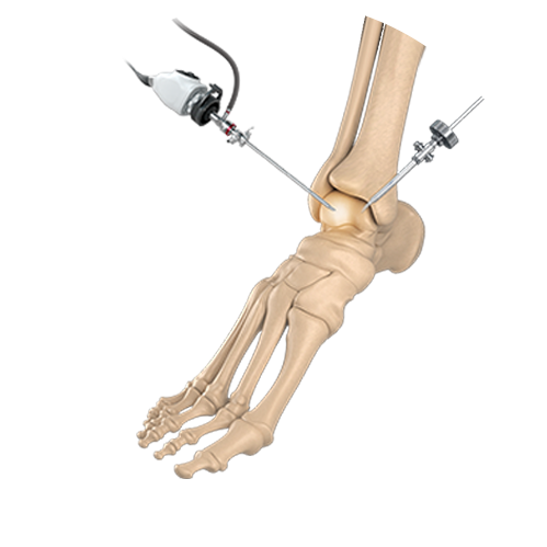 Minimally Invasive Bunion Surgery