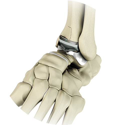 Ankle Joint Replacement