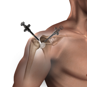 Shoulder instability repair