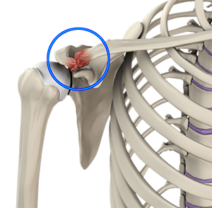Img- Acromioclavicular (AC) Joint Osteoarthritis