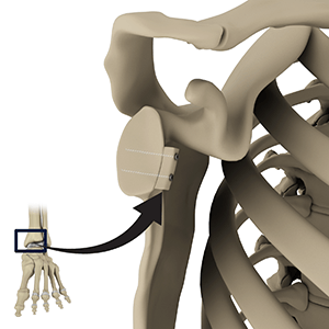Img-Distal Tibial Allograft Glenoid Reconstruction