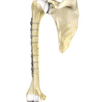 Img-Humeral Shaft Fracture Repair