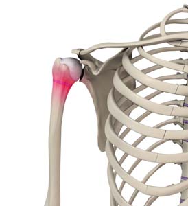 Img- Little League Shoulder