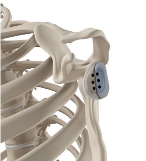 Img-Open Glenoid Bone Grafting