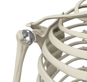 Img-Shoulder Resurfacing