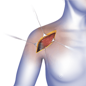 Img-Shoulder Surgery
