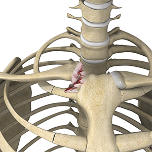 Img-Sternoclavicular Joint Reconstruction