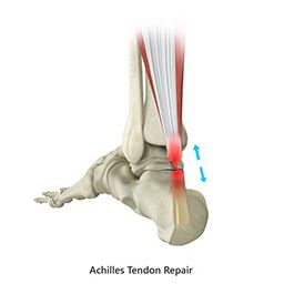 Achilles Tendon Repair sp