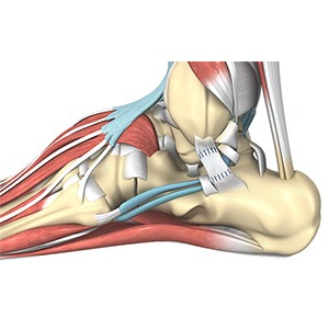 Ankle Reconstruction sp