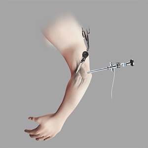 Elbow Arthroscopy sp