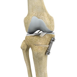 Knee Osteotomy sp