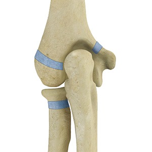 Picture of Little League Elbow