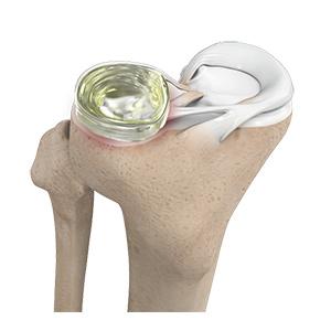 Meniscus Replacement sp