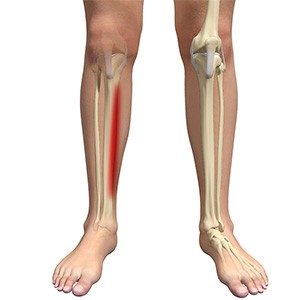 Picture of Shin Splints