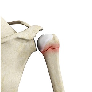 Shoulder Fracture sp