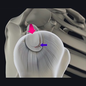 Shoulder Labral Tear with Instability sp