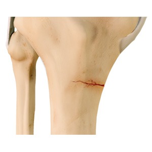 Stress Fracture of the Tibia sp