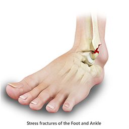 Stress Fractures of the Foot and Ankle sp