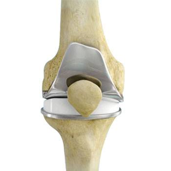 Total Knee Replacement sp