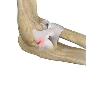 Picture of Ulnar Collateral Ligament Injury at the Elbow