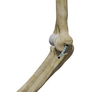 Ulnar Collateral Ligament (UCL) Repair with Internal Brace sp