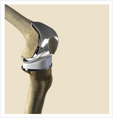 Joint Replacement Sb