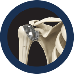 shoulder Joint Replacement