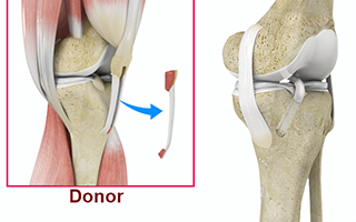 ACL Reconstruction With Allografts