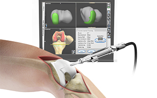 Computer Assisted Surgery