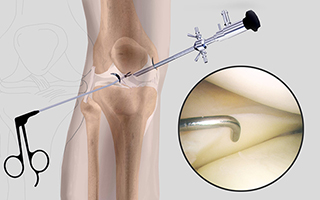 Knee Arthroscopy