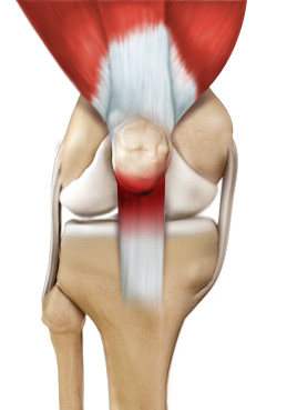 Patellar Tendinitis