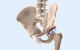 Revision Hip Replacement