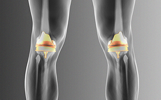 Knee Replacement