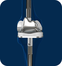 Revision Knee Replacement