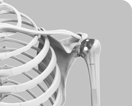 Picture of Joint Replacement