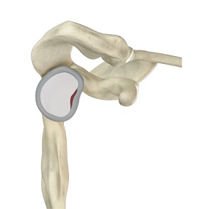 Labral Debridement and Repair