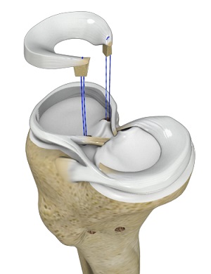 Meniscal Transplantation