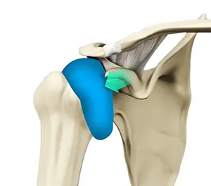 Shoulder Synovitis