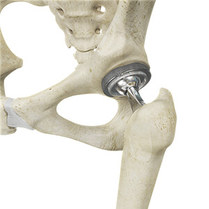 Am I a Candidate for Hip Replacement Surgery? - condition