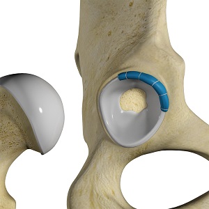 Hip Labral Reconstruction