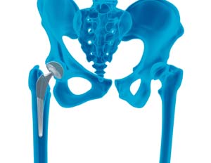 Outpatient Hip Replacement - procedure