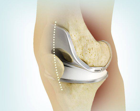 Picture of Knee Arthroplasty