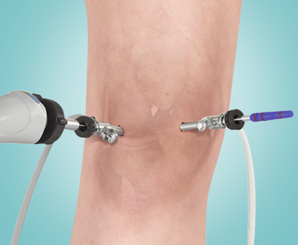 Picture of Knee Arthroscopy