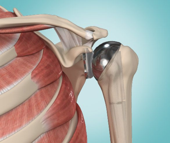 Picture of Shoulder  Arthroplasty