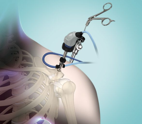 Picture of Shoulder  Arthroscopy