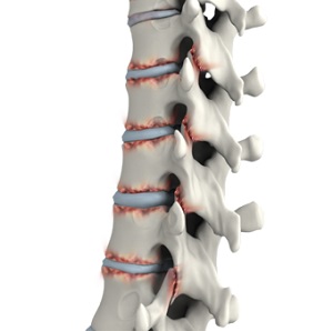 Ankylosing Spondylitis