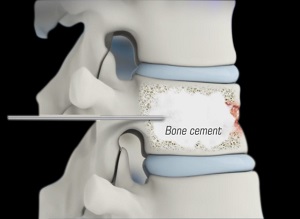 Kyphoplasty and Vertebroplasty