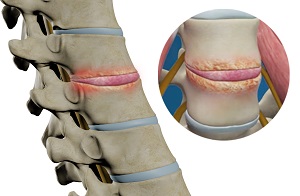 Lower Back (Lumbar) Surgery